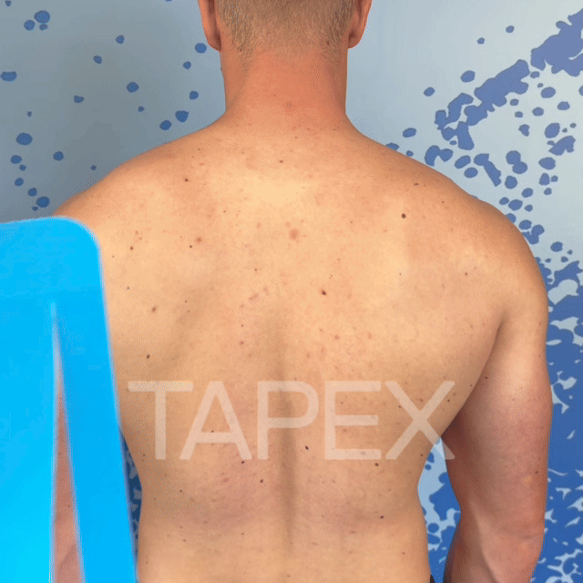 TAPEX™ - Nacken