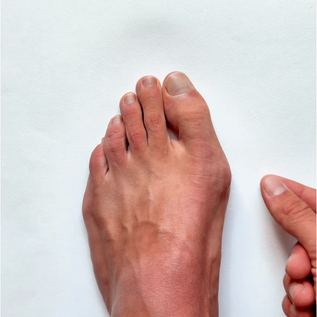 TAPEX™ Hallux-Valgus
