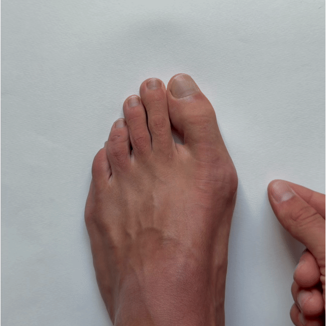 TAPEX™ Hallux-Valgus