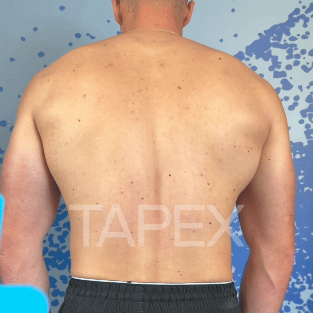 TAPEX™ - Rücken